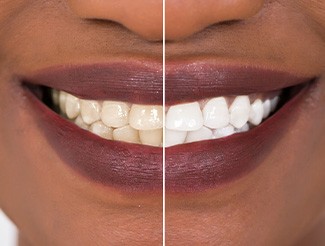 Closeup of patient's smile before and after teeth whitening