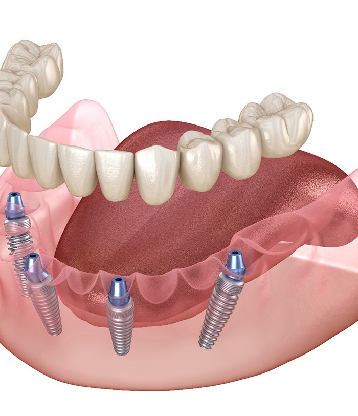 A computer-generated image of an All-on-4 implant
