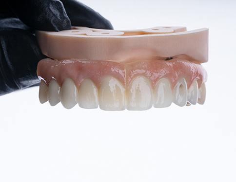 An All-on-4 dental implant on a model jaw