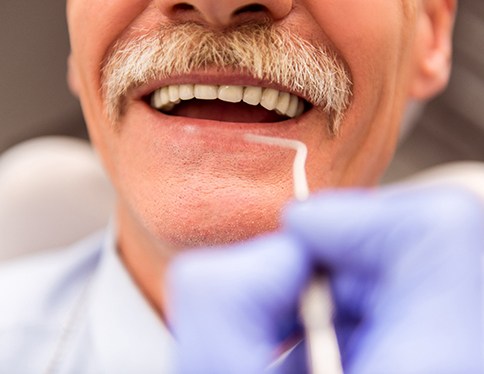 A man’s smile with All-on-4 implants
