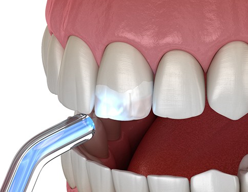 Digital image of dental bonding