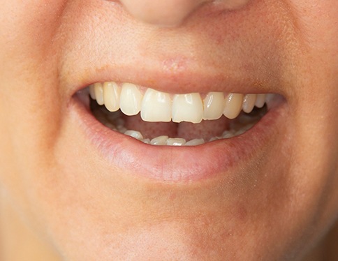 Person with a minor chip in their tooth