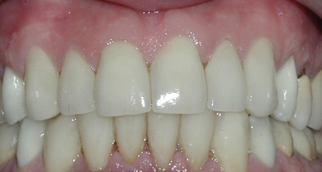 Healthy beautiful smile after dental treatment