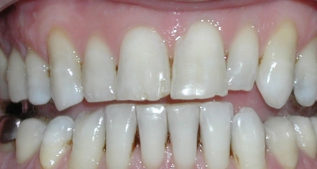 Smile with gaps between teeth and receding gums