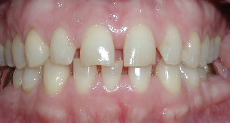 Smile with large gaps between teeth