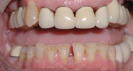Damaged and unnatural looking dental restorations