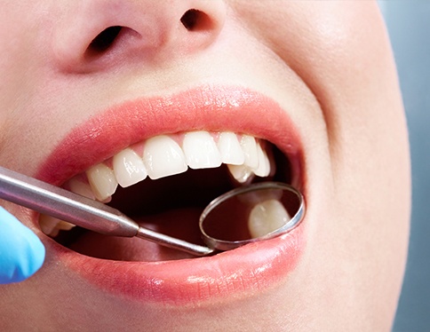 Dentist examining patient's smile after tooth colored fillings treatment