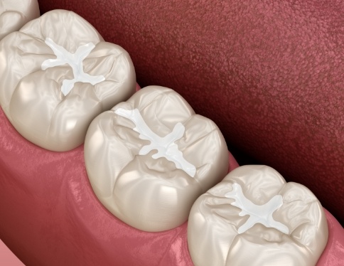 Animated teeth with dental sealants