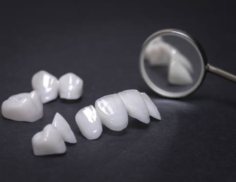 Lumineers compared with other dental restoration options