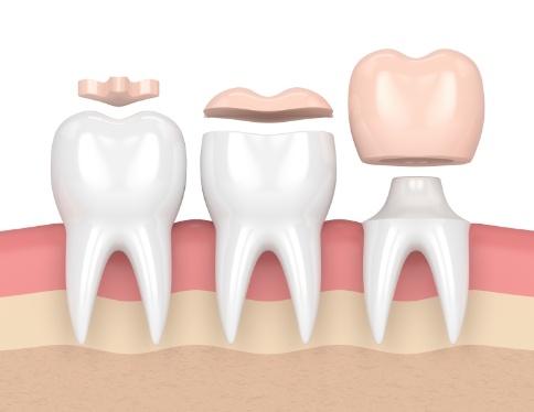 Animated teeth comparing dental crowns to other restoration options