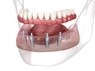 a render of implant dentures inside a mouth
