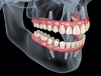an example of implant dentures in San Juan Capistrano