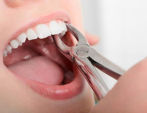 a closeup of a patient visiting their dentist for tooth extractions in San Juan Capistrano