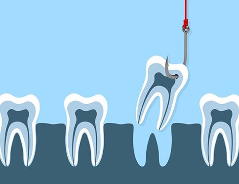 an illustration of the tooth extraction process in San Juan Capistrano