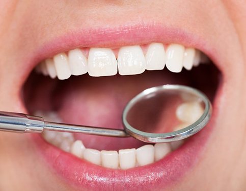Smile examined with dental mirror