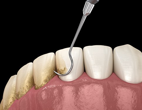 Illustration showing plaque being scraped off teeth with back background