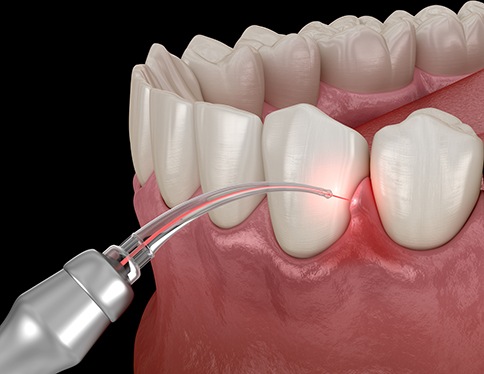 Illustration of laser gum tissue treatment
