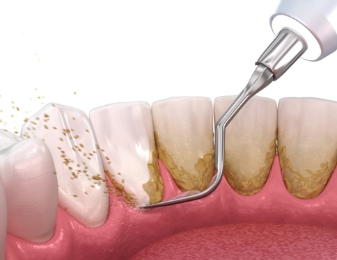 Animated smile during scaling and root planing treatment