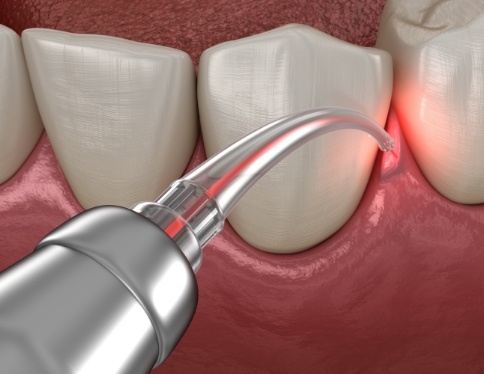 Animated smile during laser periodontal therapy