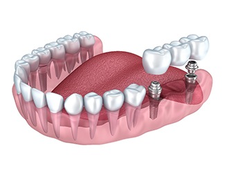 Implant bridge in San Juan Capistrano