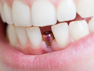Closeup of patient after paying for dental implants in San Juan Capistrano