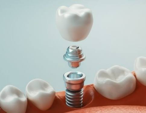 Animated smile during four step dental implant process