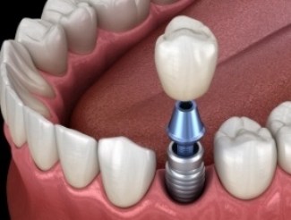 Animated smile during dental implant supported dental crown placement