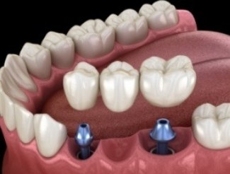 Animated smile during dental implant supported fixed bridge placement