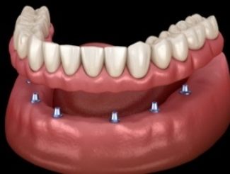 Animated smile with dental implant supported denture placement