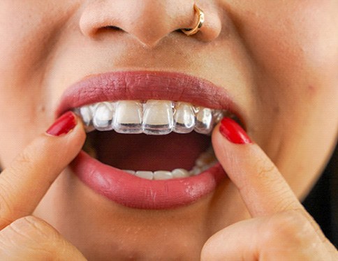 Patient putting on clear aligner