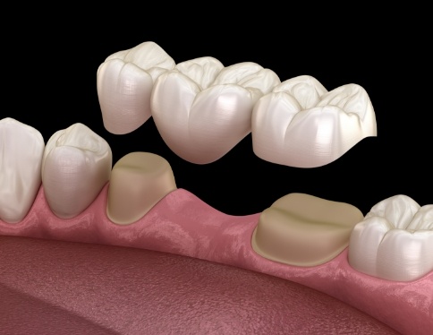 Animated smile during dental bridge placement