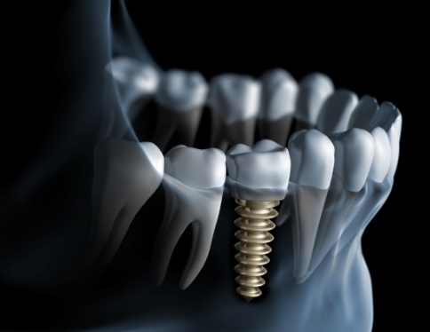 Animated smile with dental implant supported dental crown