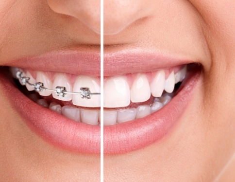 Smile with traditional orthodontics and after braces treatment