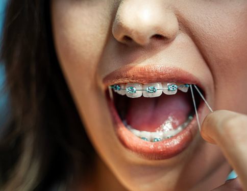 Lady handles rubber bands attached to braces