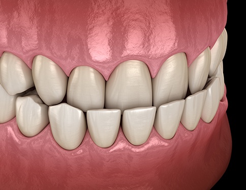 Illustration of underbite