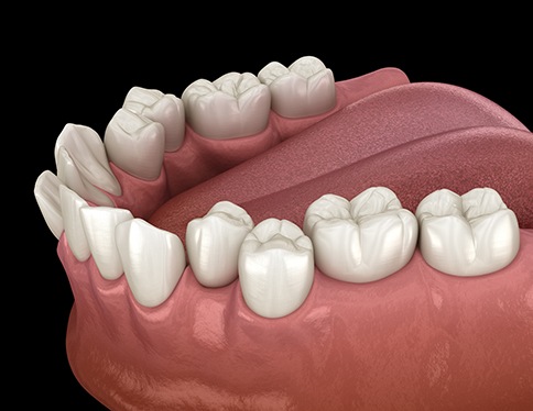 Illustration of crowded, crooked teeth