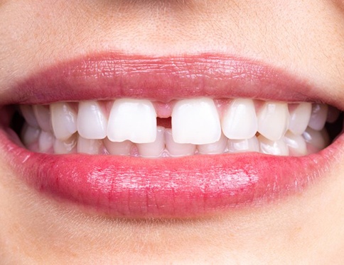 Smile with gap