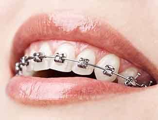 Close-up of braces on teeth