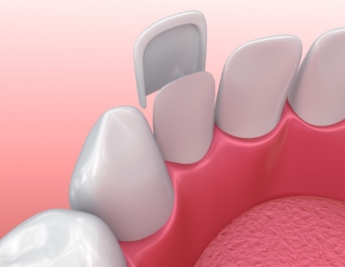 Aniamted smile during porcelain veneer placement