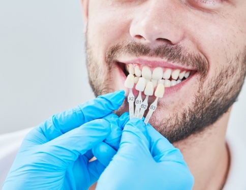 Man's smile compared to veneer color options
