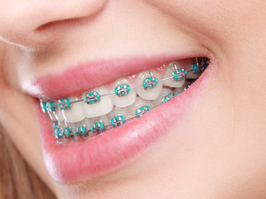 Close-up of braces being straightened by teeth
